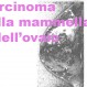 120_Carcinoma_mammella