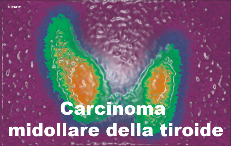 43_Carcinoma midollare