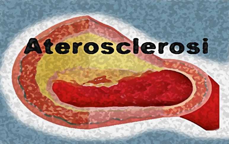 78_Aterosclerosi773