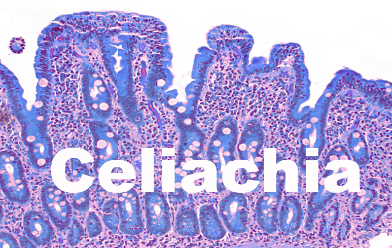 97_Malattia celiaca773