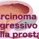 228_Carcinoma Prostata