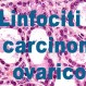 301_Carcinoma_Ovarico