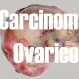 384-carcinomaovarico
