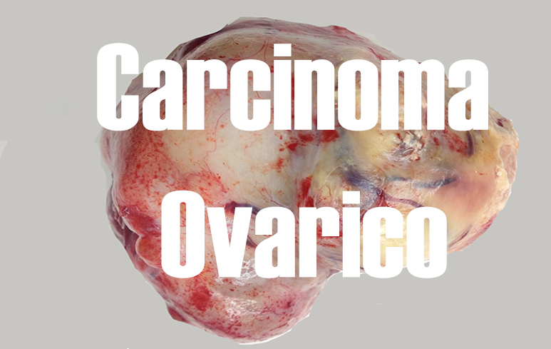 384-carcinomaovarico