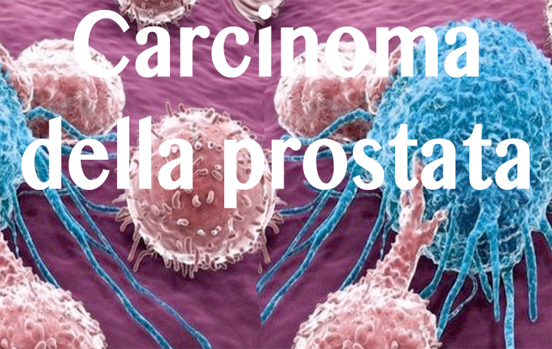 446_Carcinoma prostata