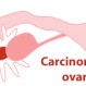 584_Carcinoma ovarico