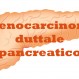 659_Carcinoma duttale pancreatico