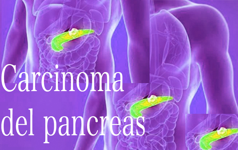 824_Carcinoma del pancreas
