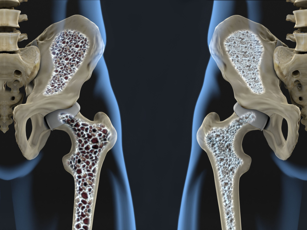 osteo